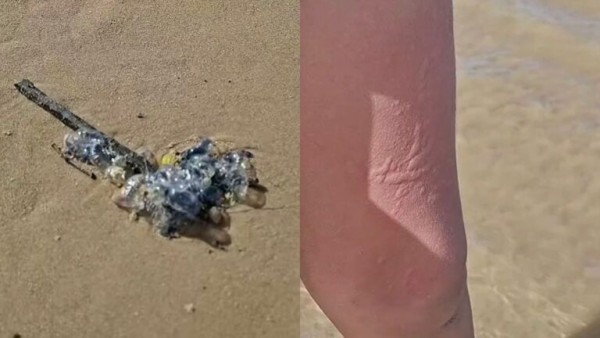 Banhistas alertam para ocorrência de queimaduras causadas por caravelas na Praia da Costa